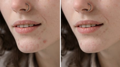 before and after image of a woman's chin, blemishes removed on the right