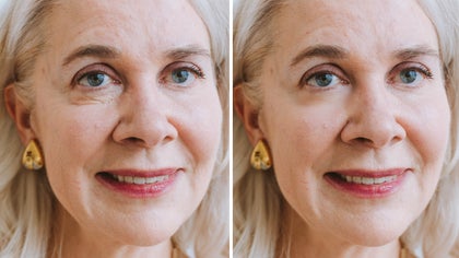 before and after image of a woman, wrinkles removed on the right